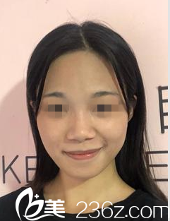 在南宁韩成做鼻综合手术前 在南宁韩成做鼻综合手术前