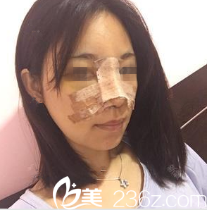 在南宁韩成做鼻综合手术后第2天 在南宁韩成做鼻综合手术后第2天