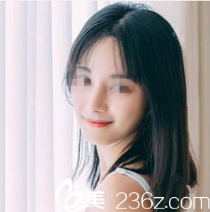 在南宁韩成做鼻综合手术后1个月 在南宁韩成做鼻综合手术后1个月