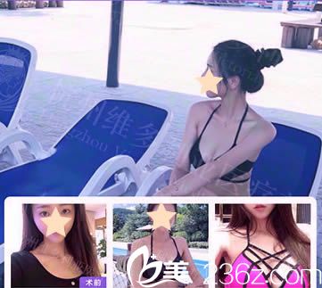 杭州维多利亚假体隆胸效果对比图 杭州维多利亚假体隆胸效果对比图