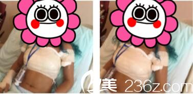 上海新星医疗整形医院吴自体脂肪隆胸真人案例坤南术后第三天