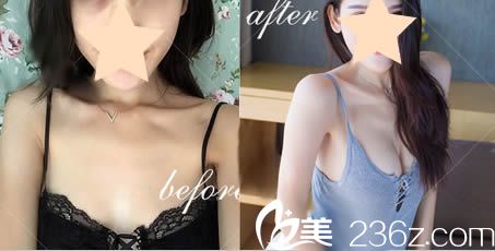 广州军美整形王世虎自体脂肪隆胸案例图 广州军美整形王世虎自体脂肪隆胸案例图