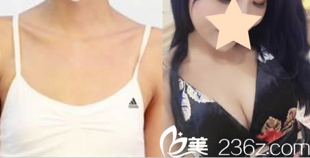 东莞水立方李志刚主任假体隆胸案例效果图 东莞水立方李志刚主任假体隆胸案例效果图