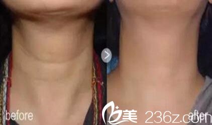 嗨体美颈针祛颈纹真人前后对比