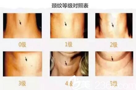 颈纹等级对照表