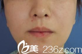 阿部圣孝鼻下长短缩术前 阿部圣孝鼻下长短缩术前