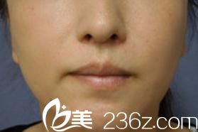 日本唇整形哪家医院好?看我在横滨ABE整形外科医院找阿部圣孝做的樱桃小嘴