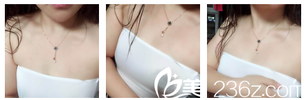 在无锡坤如玛丽隆胸前平胸 在无锡坤如玛丽隆胸前平胸