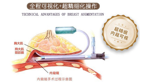 南宁韩成内窥镜丰胸