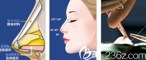 南宁韩成肋软骨隆鼻