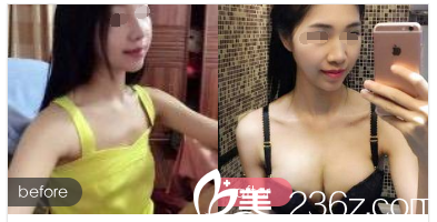 术后一周拆线假体隆胸前后对比