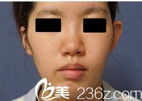 假体隆鼻前 假体隆鼻前