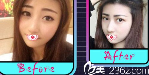 张晓亮院长做眼综合案例 张晓亮院长做眼综合案例