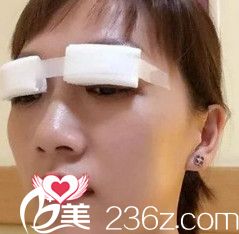 张晓光医生为我刚做完双眼皮修复后有点肿胀