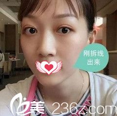 邯郸华美张晓光做埋线双眼皮修复术后7天眼睛消肿很多