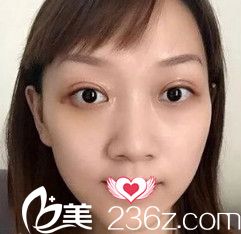 在邯郸华美做眼综合术后16天眼睛线条流畅