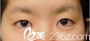 埋线双眼皮前 埋线双眼皮前