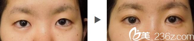 埋线双眼皮前后对比 埋线双眼皮前后对比