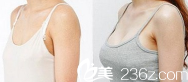 太原华美罗盛康隆胸失败修复效果图