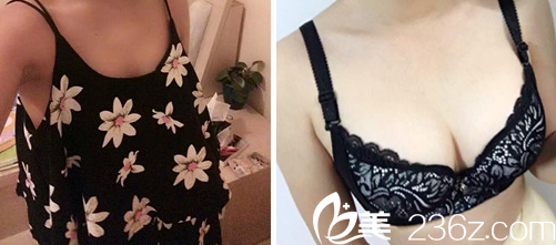 太原美媛荟整形隆胸前后对比图