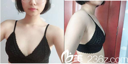 在北京美莱做脂肪丰胸前样子 在北京美莱做脂肪丰胸前样子