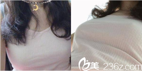 <!--<i data=20240703-sp></i>-->给我做脂肪丰胸第21天效果 <!--<i data=20240703-sp></i>-->给我做脂肪丰胸第21天效果