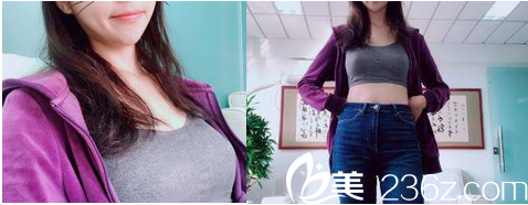 在北京美莱做脂肪丰胸第45天效果 在北京美莱做脂肪丰胸第45天效果