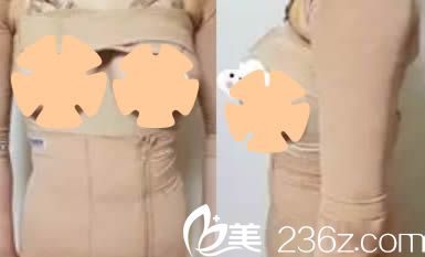 我在韩国珠儿丽腰腹吸脂和假体隆胸术后三天照 我在韩国珠儿丽腰腹吸脂和假体隆胸术后三天照