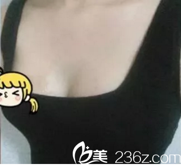 术后一周的效果