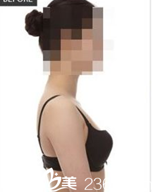 手术前照片 手术前照片