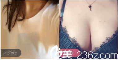 北京印正山郑泰成隆胸案例