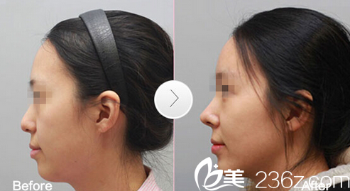 深圳福田军科整形刘月更隆鼻子案例 深圳福田军科整形刘月更隆鼻子案例