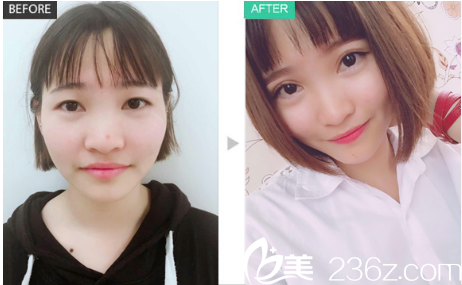 深圳福田军科整形医院2019年整形价格表 刘月更双眼皮3800元,隆鼻16800元,隆胸8800元