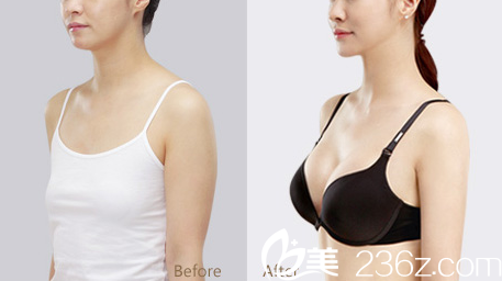 深圳军科刘月更隆胸怎么样 深圳军科刘月更隆胸怎么样