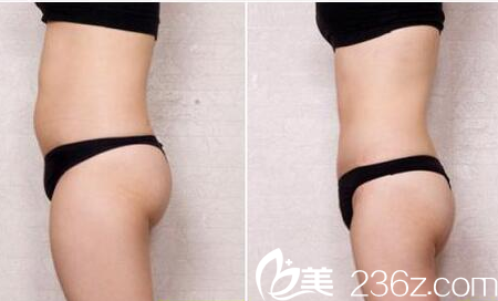 深圳军科吸脂怎么样 深圳军科吸脂怎么样