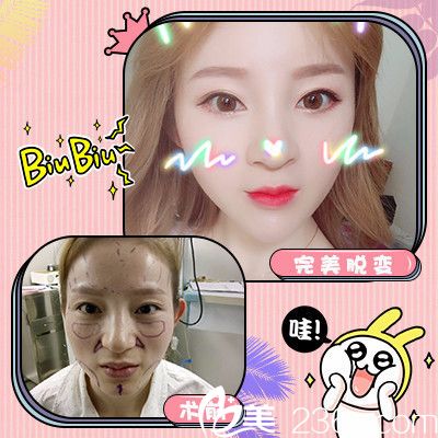 深圳军科刘月更面部脂肪填充案例 深圳军科刘月更面部脂肪填充案例