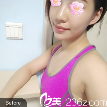 <!--<i data=20240703-sp></i>-->隆胸术前照片 <!--<i data=20240703-sp></i>-->隆胸术前照片