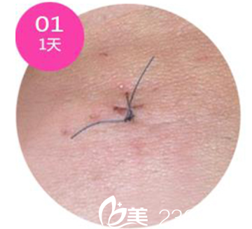 韩国安瑟林疤痕恢复天 韩国安瑟林疤痕恢复天