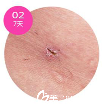 韩国安瑟林医院疤痕恢复第7天 韩国安瑟林医院疤痕恢复第7天