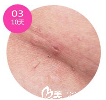 韩国安瑟林医院疤痕恢复第10天 韩国安瑟林医院疤痕恢复第10天