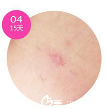 韩国安瑟林医院疤痕恢复第15天 韩国安瑟林医院疤痕恢复第15天