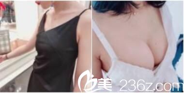 上海时光整形外科医院自体脂肪隆胸真人案例