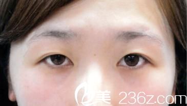 竹内重夫埋线双眼皮前 竹内重夫埋线双眼皮前