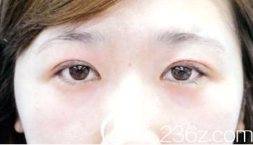 竹内重夫埋线双眼皮手术后当天照片 竹内重夫埋线双眼皮手术后当天照片