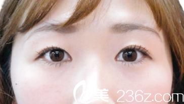 竹内重夫埋线双眼皮术后两个月 竹内重夫埋线双眼皮术后两个月