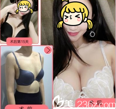 北京玲珑梵宫自体脂肪丰胸特惠进行中！王光辉自体脂肪丰胸12800元起附案例