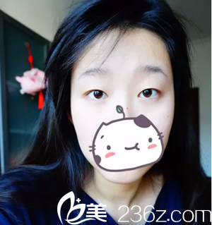 双眼皮手术前照片 双眼皮手术前照片