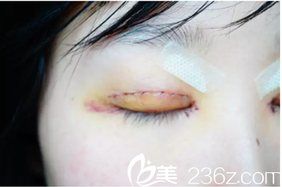 术后两天 术后两天