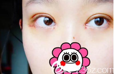 7天,拆线了 7天,拆线了