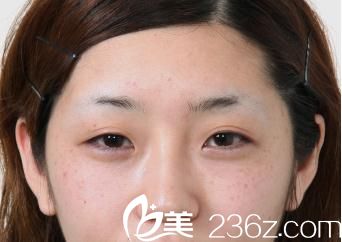 开内眼角手术前 开内眼角手术前